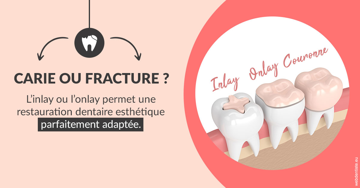 https://www.dentiste-pineau.fr/T2 2023 - Carie ou fracture 2