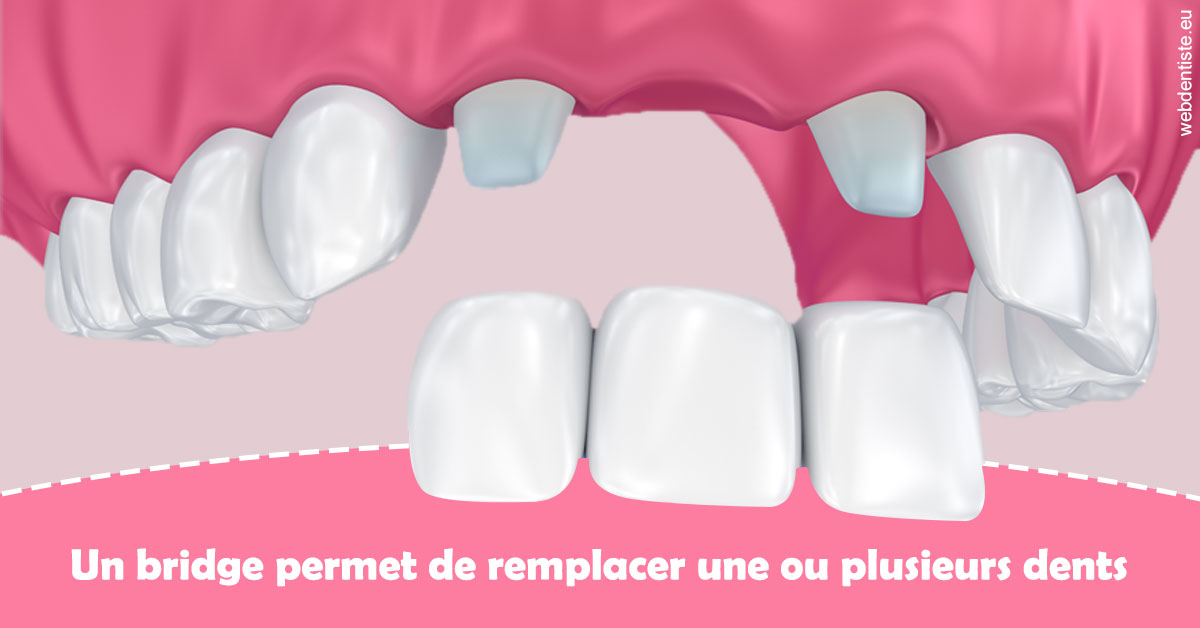 https://www.dentiste-pineau.fr/Bridge remplacer dents 2