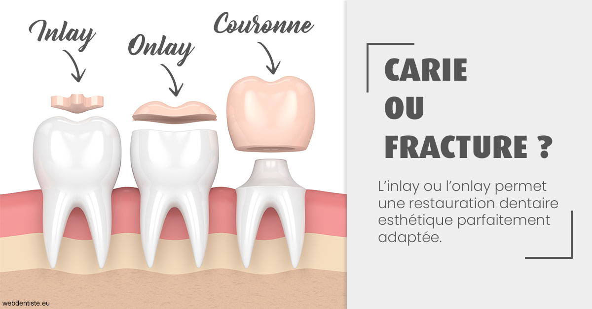 https://www.dentiste-pineau.fr/T2 2023 - Carie ou fracture 1