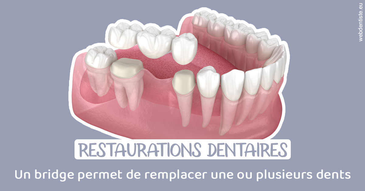 https://www.dentiste-pineau.fr/Bridge remplacer dents 1