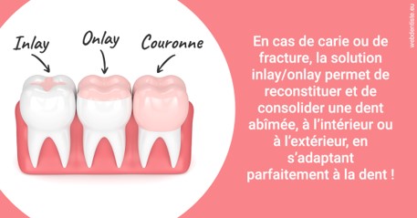 https://www.dentiste-pineau.fr/L'INLAY ou l'ONLAY 2