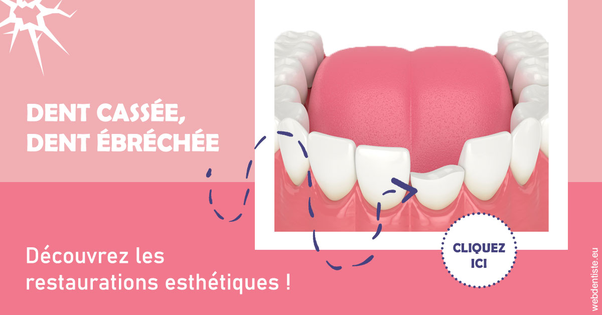 https://www.dentiste-pineau.fr/Dent cassée ébréchée 1